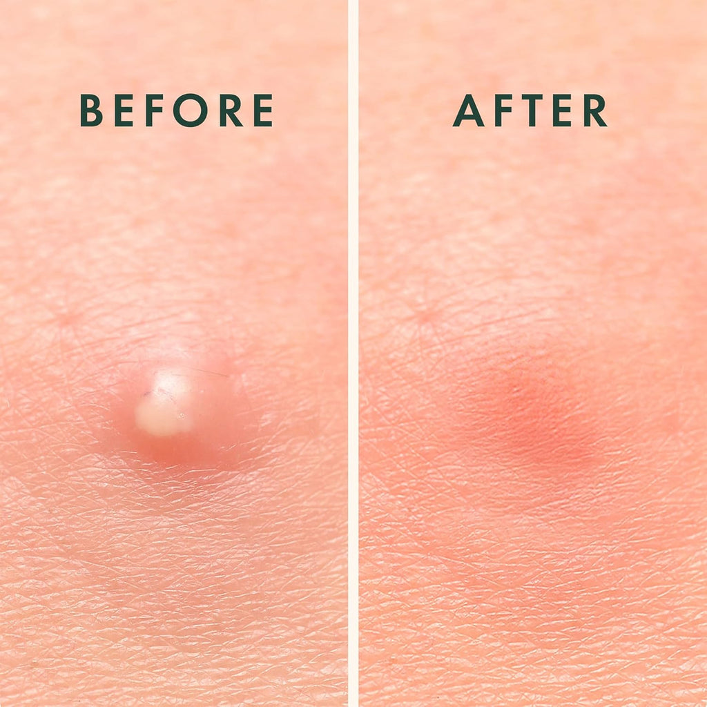 Rael Acne Pimple Patches